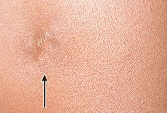 寶寶打過(guò)卡介苗的地方紅腫化膿了，該怎么辦？